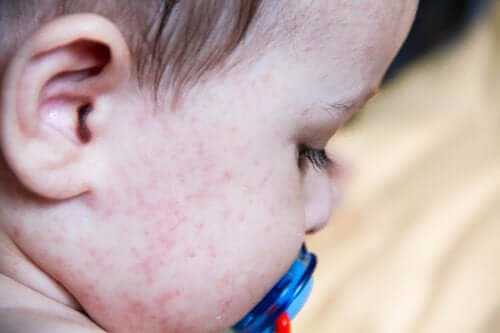 Alergia ao látex em crianças
