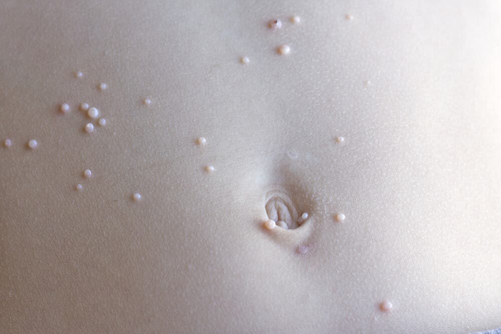 O que fazer se meu filho tiver molusco contagioso?