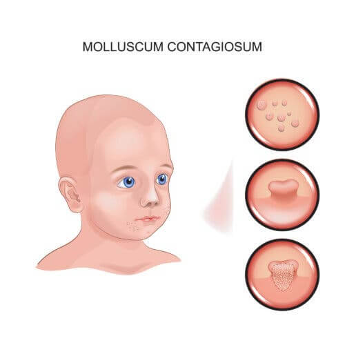 meu filho está com molusco contagioso