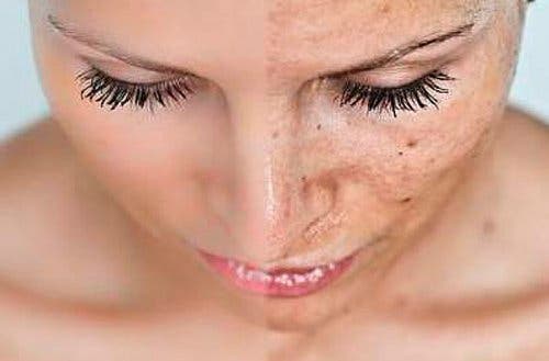 É muito comum aparecerem manchas ou alterações na pele durante a gravidez. Essas marcas geralmente aparecem como manchas escuras, comumente conhecidas como máscara da gravidez; o seu nome médico é cloasma ou melasma. No início da gravidez, o corpo da mulher passar por mudanças todos os meses. Inclusive, são registradas alterações que podem causar desconforto e é necessário estar devidamente preparada para elas. Você sabe como agir diante das manchas que aparecem na pele? Por que há manchas e alterações na pele durante a gravidez? Durante os nove meses de gestação, os níveis hormonais aumentam e é possível que isso cause manchas na pele de algumas mães. É justamente esse aumento de hormônios que gera as manchas no corpo. Os cloasmas, também conhecidos como melasma ou "máscara da gravidez", são manchas que aparecem no rosto, na maioria dos casos, durante a gravidez. Às vezes, podem causar coceira. No entanto, as suas consequências não vão além da estética. De fato, as manchas podem causar mais problemas emocionais do que físicos, pois geralmente afetam a autoestima da mulher, que se sente preocupada e envergonhada pela sua aparência. A grande maioria das alterações na pele durante a gravidez aparece na área do rosto, principalmente na testa, no nariz, nas maçãs do rosto e nas bochechas. Elas também se manifestam no lábio superior e, menos comumente, ao redor dos olhos. Além disso, também podem aparecer em áreas como antebraços, axilas, virilha, barriga e outros lugares expostos ao sol. Essas manchas marrons aparecem, na maioria dos casos, durante os últimos seis meses de gravidez. Além disso, elas também podem aparecer devido a fatores genéticos; assim, é possível ser mais propensa a desenvolvê-las se houver familiares diretos que já apresentaram essas características anteriormente. Tipos de cloasma Existem três tipos de cloasma, que dependem da profundidade da melanina: • Dérmico: Aparece na derme, apresenta bordas difusas e se localiza nas maçãs do rosto. • Epidérmico: Ocorre nas camadas epidérmicas, possui bordas ligeiramente mais definidas e se localiza no centro da face. Geralmente é o mais fácil de tratar. • Misto: É a combinação dos anteriores e pode ser mais difícil de tratar. É frequente em mulheres grávidas, que os produzem naturalmente; é conhecido como "cloasma gravídico" em mulheres grávidas. «Durante os nove meses de gestação, os níveis hormonais aumentam e é possível que isso cause manchas na pele de algumas mães» É possível evitar as manchas na pele? A maneira exata de evitar essas manchas é desconhecida. Cada gravidez é diferente da outra e nem todas as mulheres grávidas têm essas alterações na pele; portanto, após o parto, as manchas podem desaparecer por conta própria. No entanto, na maioria dos casos, elas não desaparecem completamente. Em caso de dúvida ou preocupação a esse respeito, é essencial consultar um especialista. Tratamento para as alterações da pele durante a gravidez É aconselhável evitar alguns tratamentos durante a gravidez, pois estes podem promover ainda mais o desenvolvimento da melanina e causar mais manchas na pele. No entanto, existem alguns métodos recomendados, embora qualquer um deles deva ser aprovado por um especialista. • Protetor solar: Deve ser usado continuamente para proteger a pele e as manchas que aparecerem, sempre de acordo com as instruções de um dermatologista. • Menor exposição ao sol: Se essas alterações na pele ocorrerem durante a gravidez, o tempo de exposição da pele ao sol deve ser reduzido, especialmente a área do rosto. Recomenda-se o uso de chapéus, óculos ou outros acessórios. • Sessões de laser: Se as manchas não desaparecerem completamente após o parto e nenhum tratamento anterior tiver funcionado, você sempre poderá recorrer a sessões de laser. Isso ajudará a remover a pigmentação em aproximadamente dez sessões, sempre com as instruções de um dermatologista. • Cuidados com a pele: É necessário ser muito rigoroso quando se trata da higiene da pele. Recomenda-se uma rotina de limpeza e hidratação do rosto, usando sabonetes e cremes de tipos adequados para a pele. Pode levar vários meses até que seja vista uma melhora na sua pele; portanto, é de vital importância continuar a se proteger do sol durante e após o tratamento. Caso as manchas persistam, é aconselhável procurar um dermatologista para determinar a causa das alterações e o tratamento adequado.