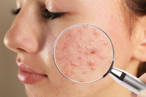Acne juvenil: tipos e causas