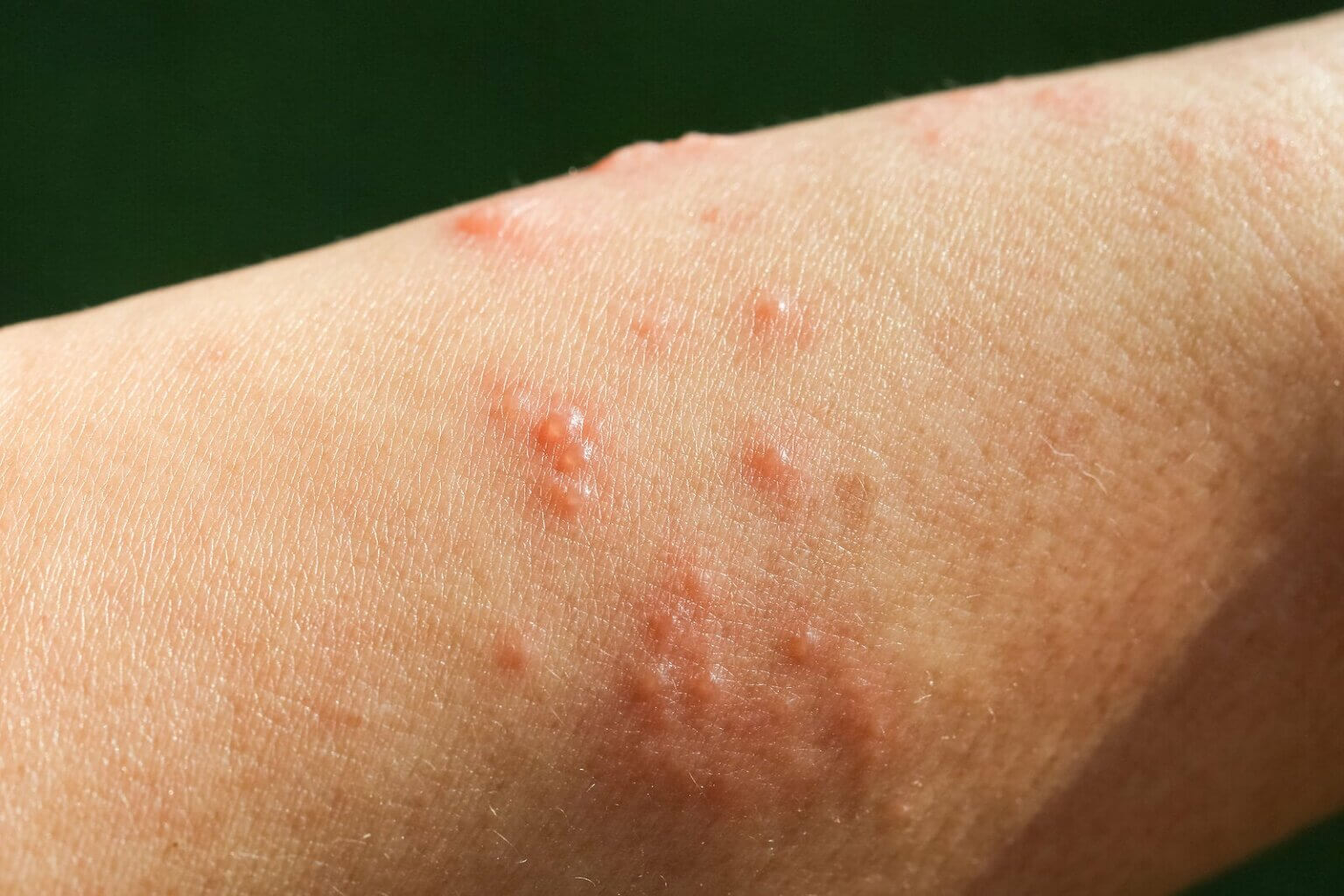 bed-bug-rash-on-face-vrogue-co