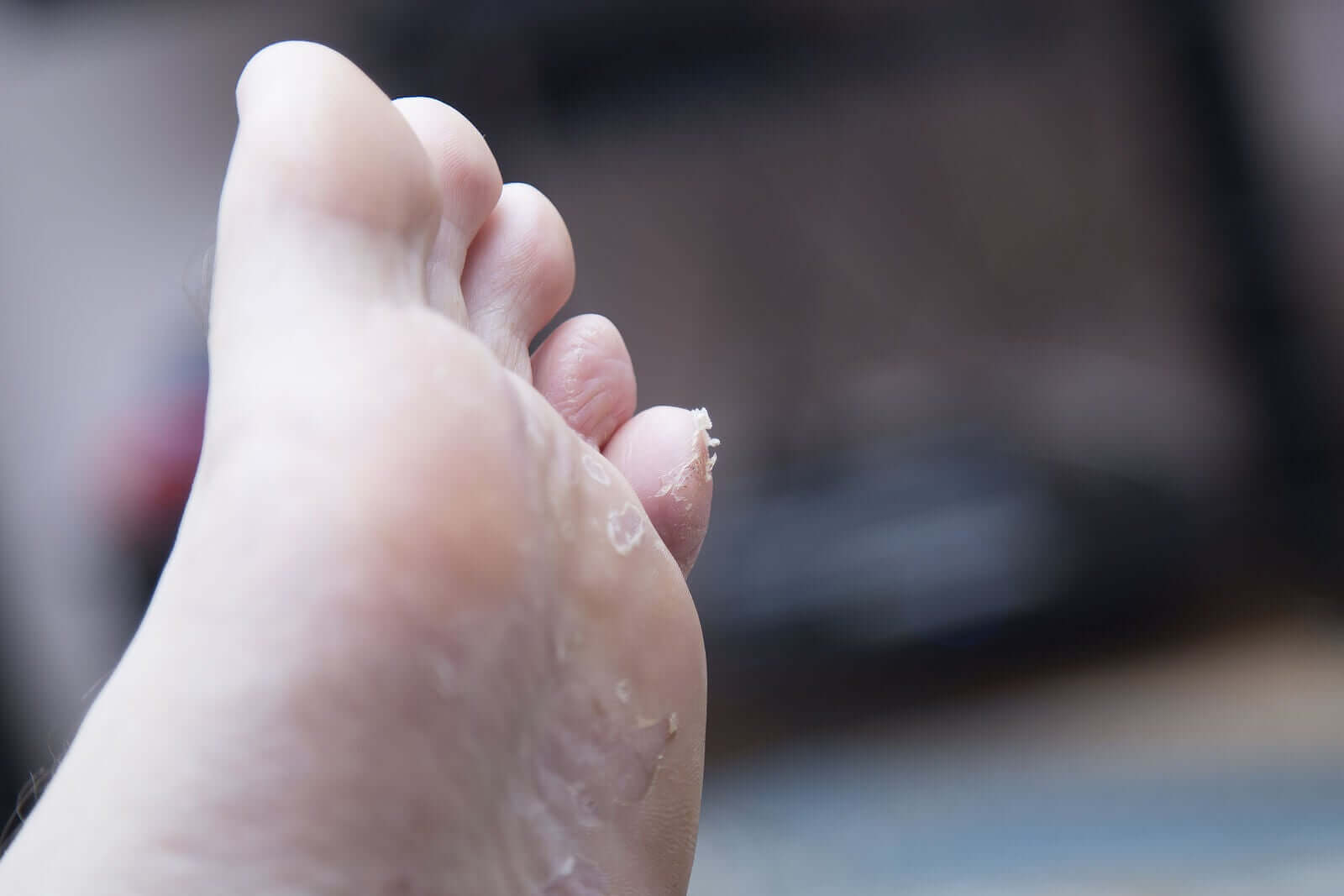 Dermatose palmoplantar juvenil