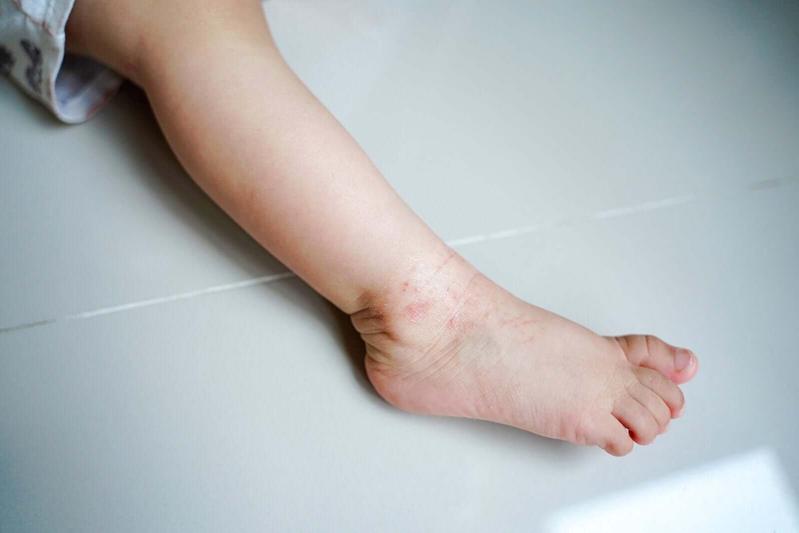 Eczema em bebês