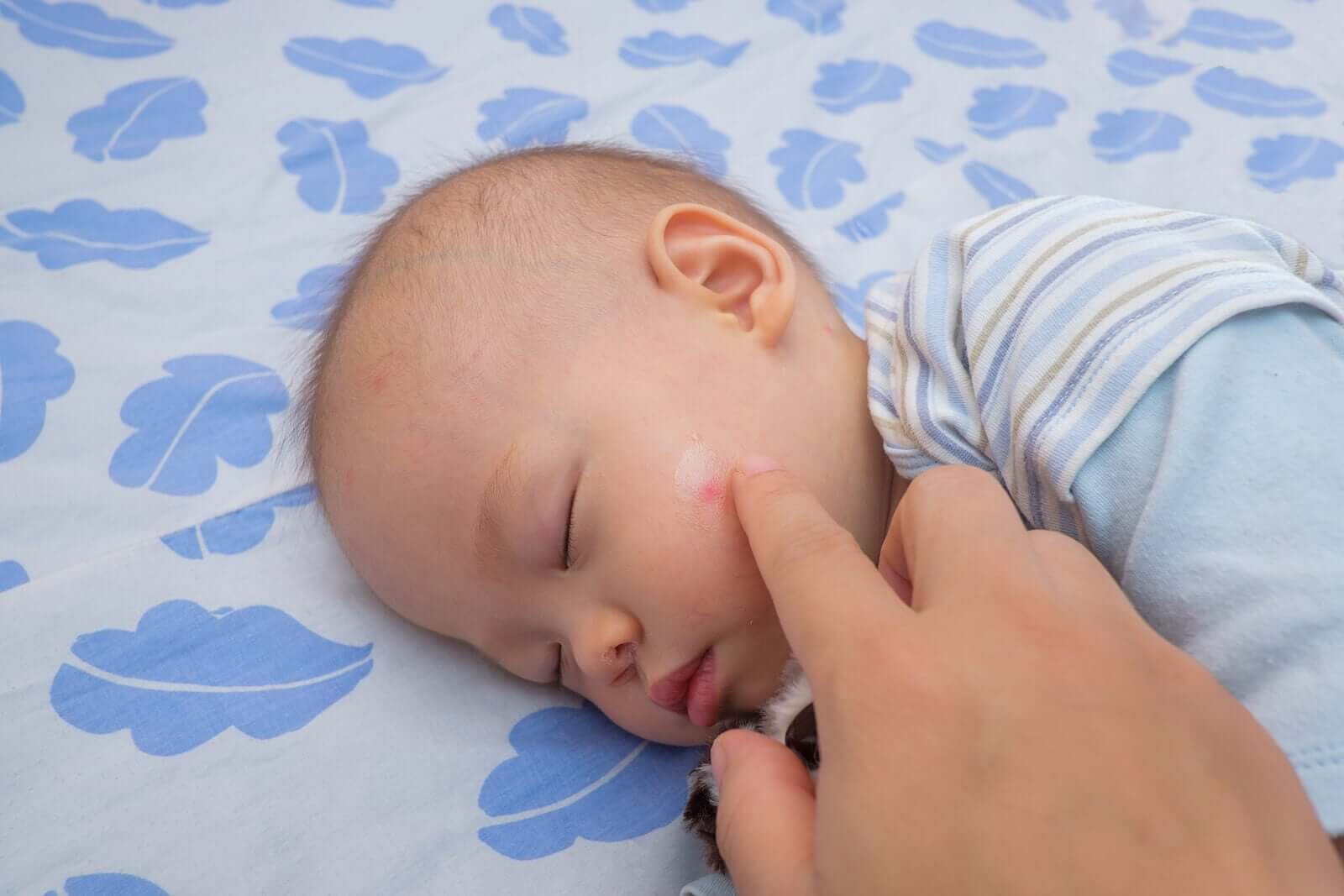 Alergia a picadas em bebês e crianças