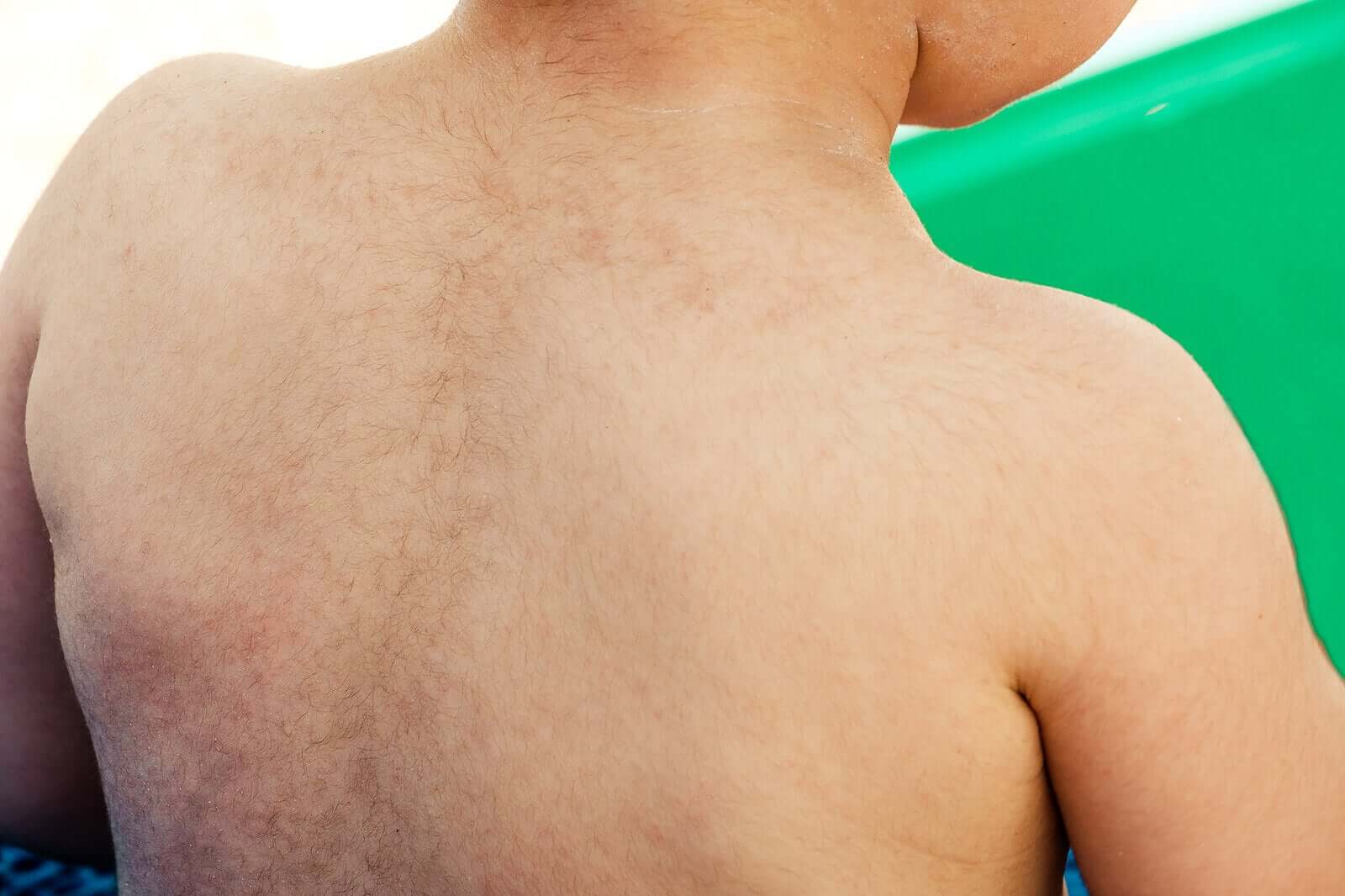 Hirsutismo ou excesso de pelos em crianças