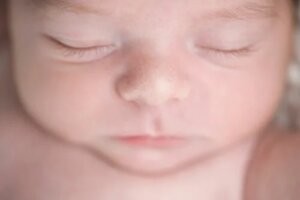 Miliums ou miliária em bebês: em que consiste?