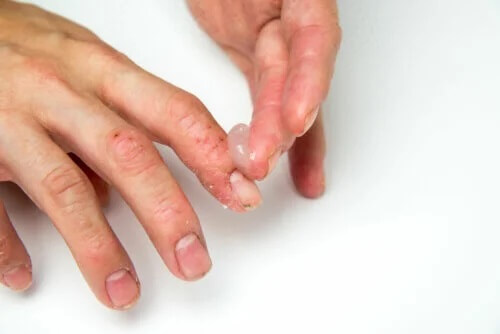 Eczema disidrótico em crianças: como tratar?
