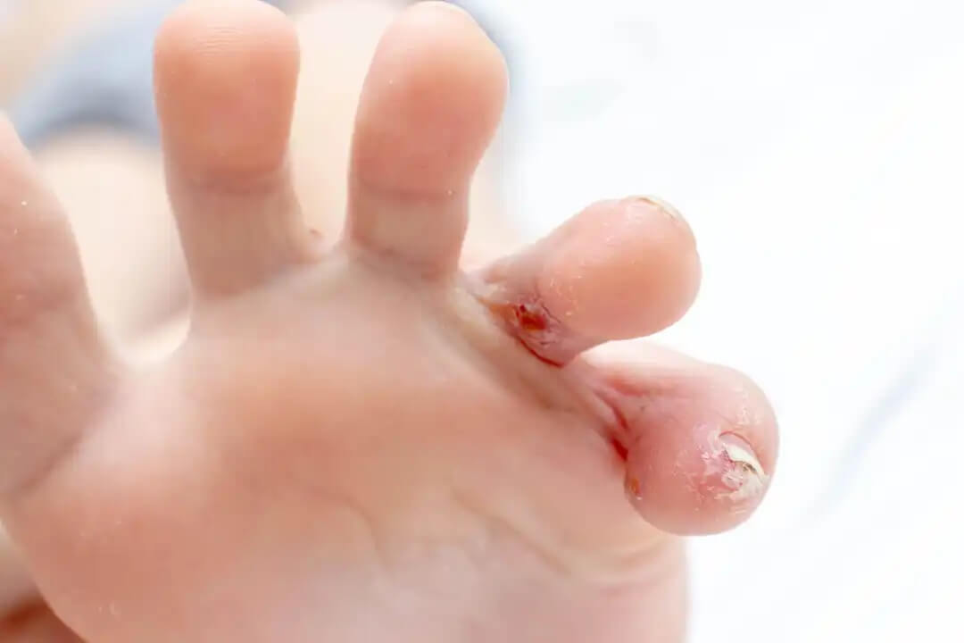 Pés com eczema disidrótico