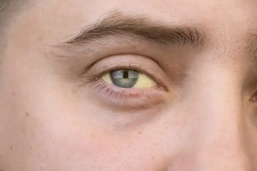 Pessoa com olhos amarelados devido à hepatite C.