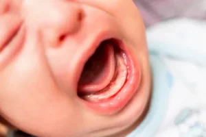 Pérolas de Epstein em bebês: o que são e por que aparecem?