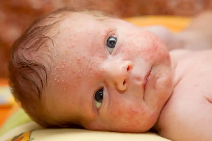 Recém-nascido com acne neonatal.