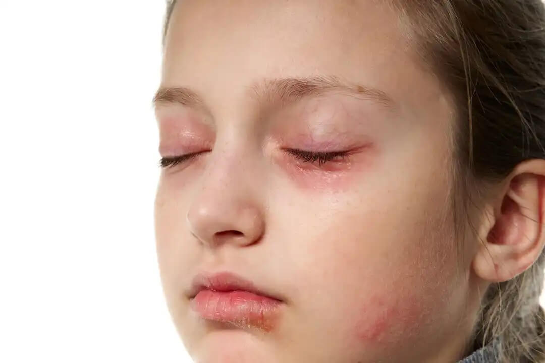 Olhos inchados: eczemas em crianças.