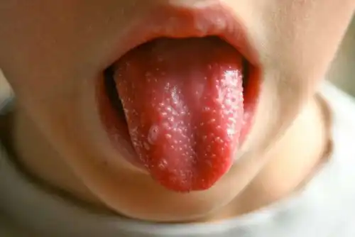 Sintomas da escarlatina em crianças.