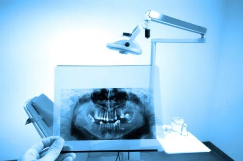 Radiografia odontológica: o que você precisa saber