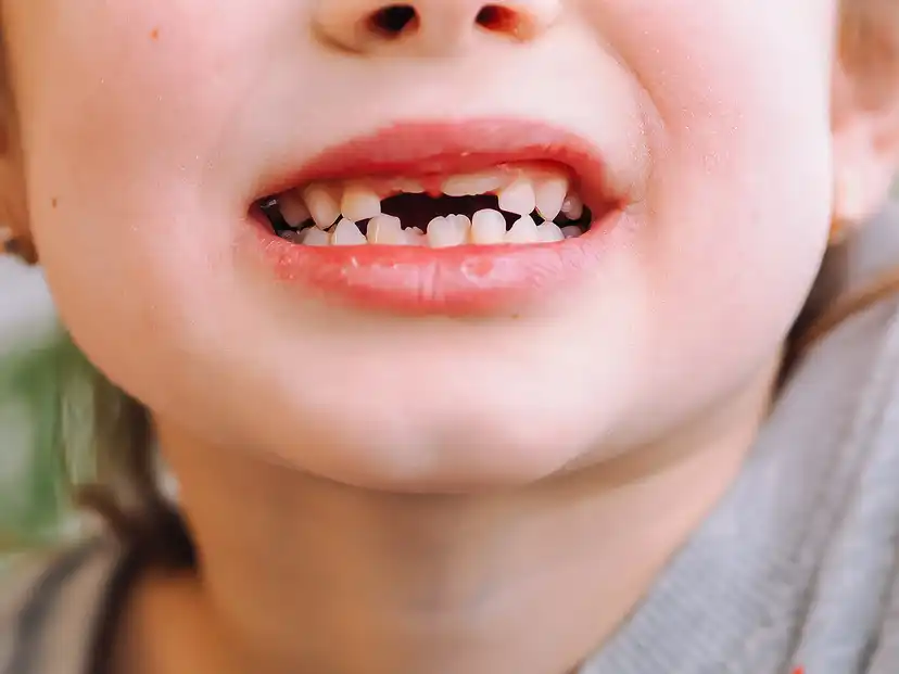 Você sabe o que são os dentes de tubarão na infância?