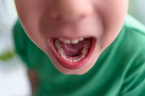Dupla fileira de dentes em crianças: o que fazer?