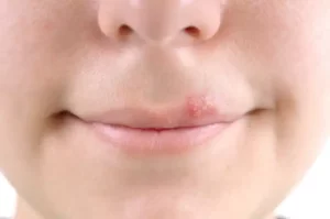 Tratamento natural para herpes em crianças