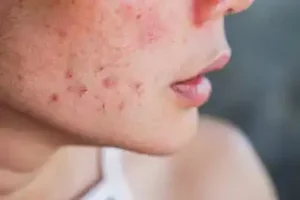10 remédios caseiros contra acne durante a gravidez