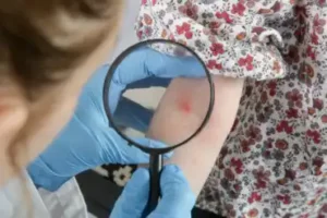 Remédios naturais para dermatite atópica em bebês e crianças