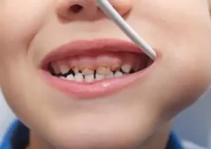 Por que meu filho tem um dente de leite escurecido?