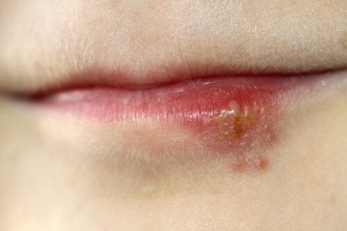 Herpes labial durante a gravidez: o que você precisa saber