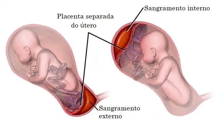O que é a placenta normalmente inserida?