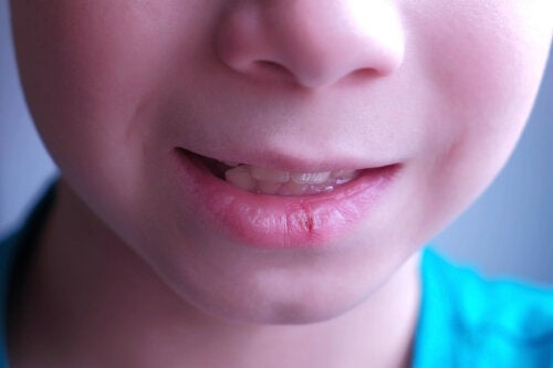 Lábios rachados em crianças: causas e recomendações