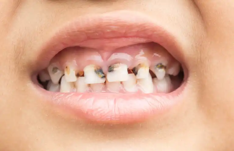 É necessário tratar as cáries em dentes de leite?