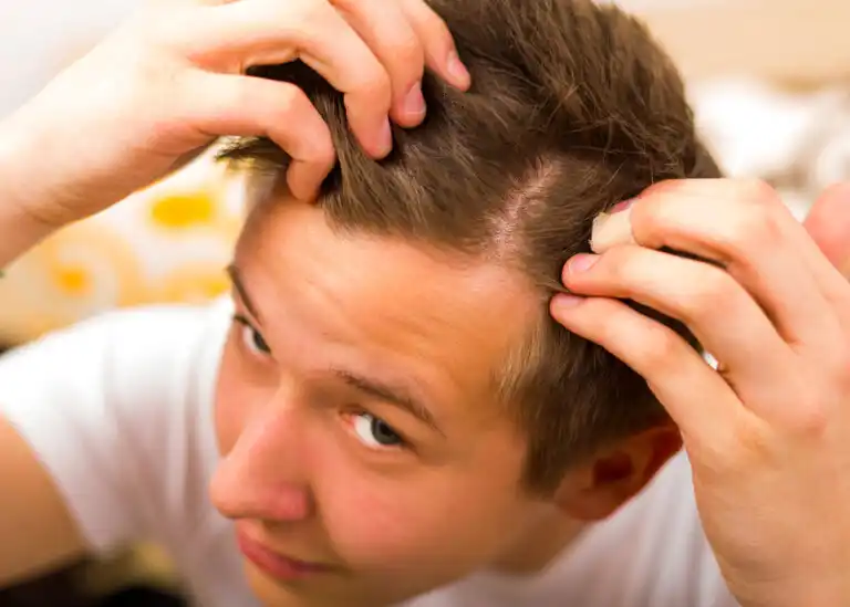 Como prevenir a alopecia juvenil