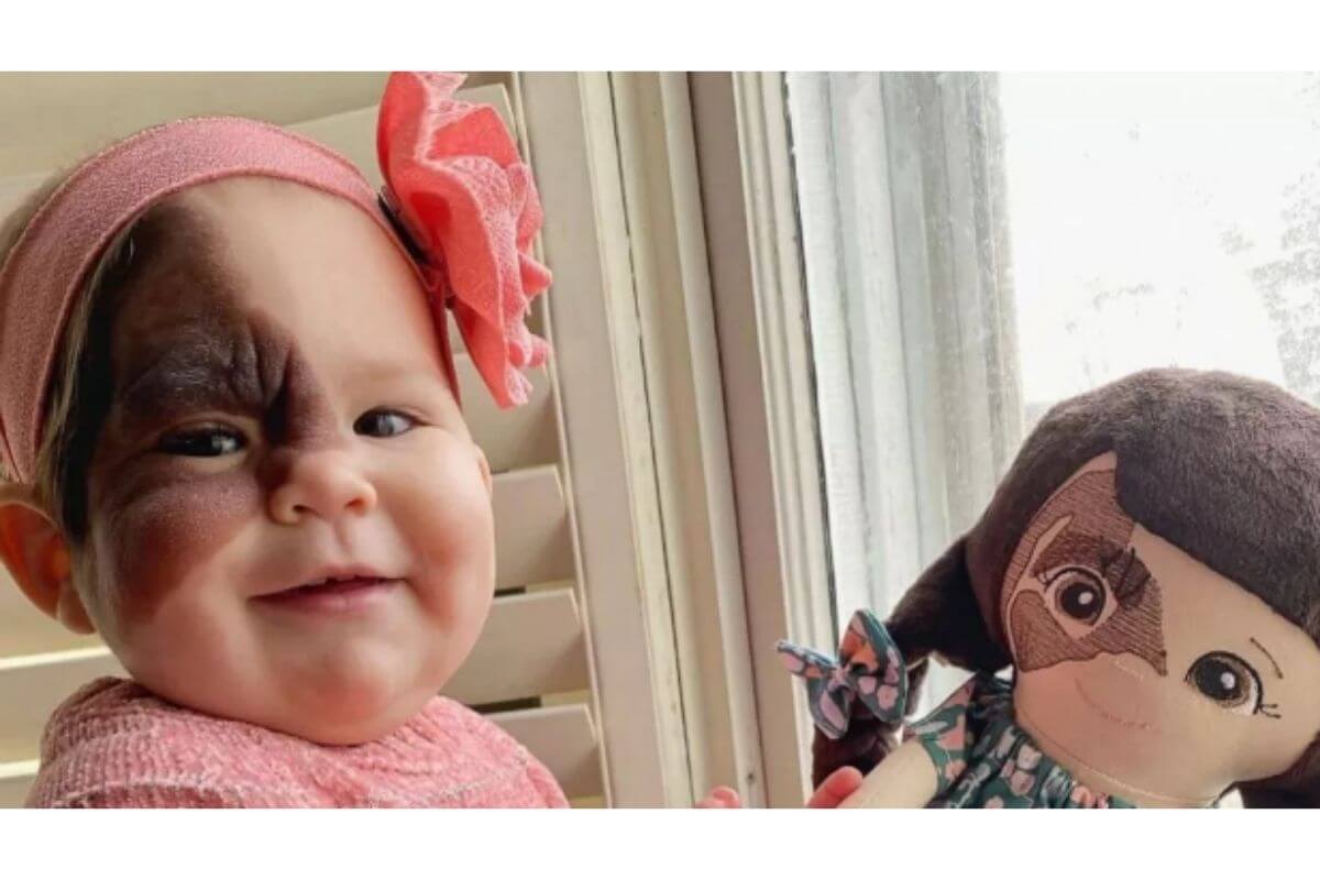 Mãe faz desabafo para conscientizar sobre marca de nascença da filha