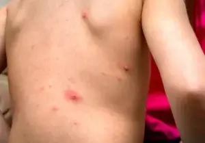 Erupções cutâneas mais frequentes em crianças de acordo com a idade