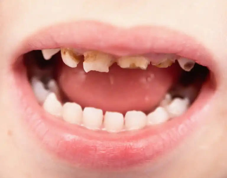 Dentes lascados em crianças: causas e tratamentos