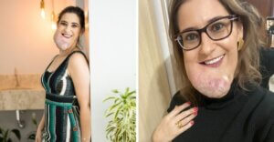 Mulher com hemangioma é exemplo de empoderamento e amor-próprio