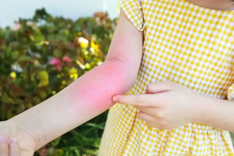 10 dicas para tratar a dermatite de contato