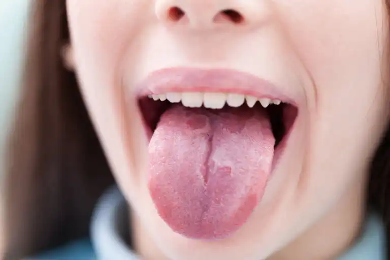 6 doenças da infância com manifestações na língua