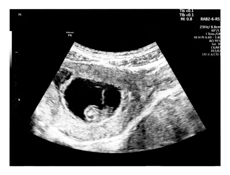 Ultrassom na 6ª semana de gravidez o que você vai ver? Sou Mamãe