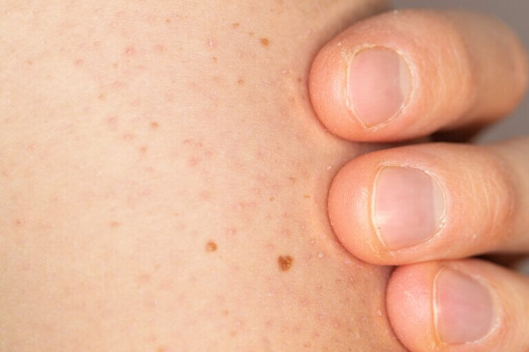 Como cuidar da pele com queratose pilar em crianças?