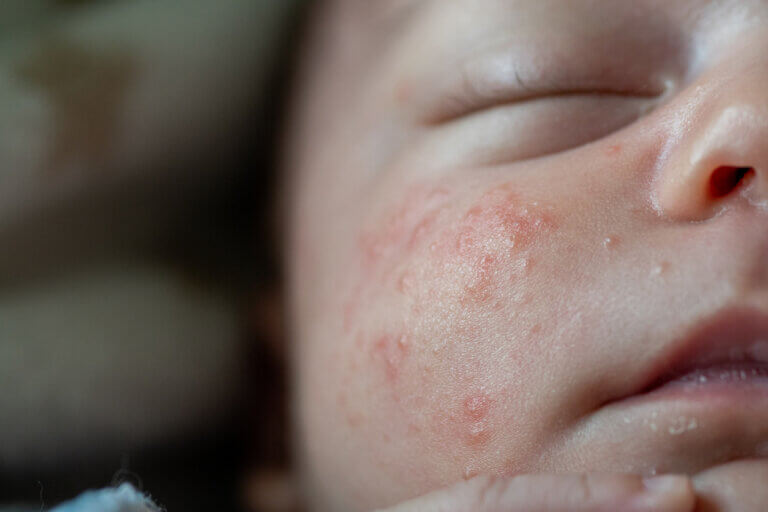 Lesões benignas na pele do bebê: tipos e cuidados