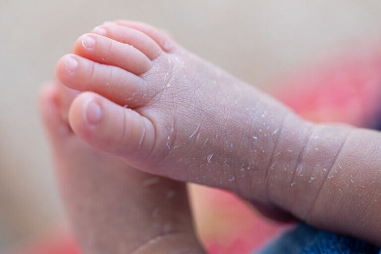 Causas de descamação da pele em um bebê