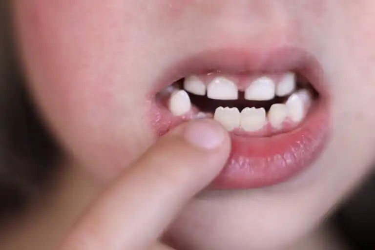 Dentes em forma de serra: são normais?