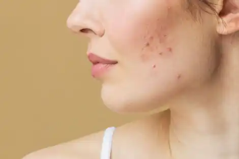 Acne P S Parto Causas E Tratamento Sou Mam E