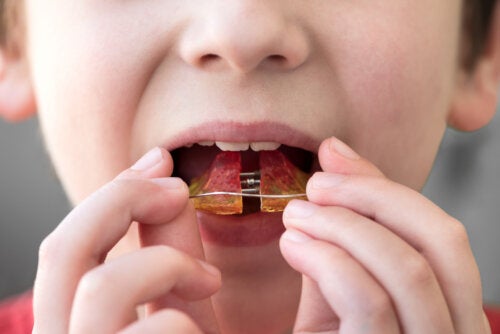 Ortodontia infantil: em qual idade pode começar?