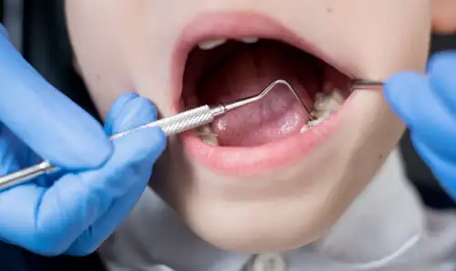 Os 6 tratamentos dentários mais comuns em crianças